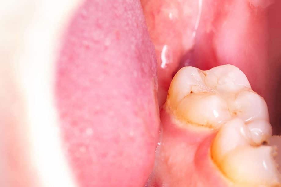 What Is A Dry Socket After A Tooth Extraction?